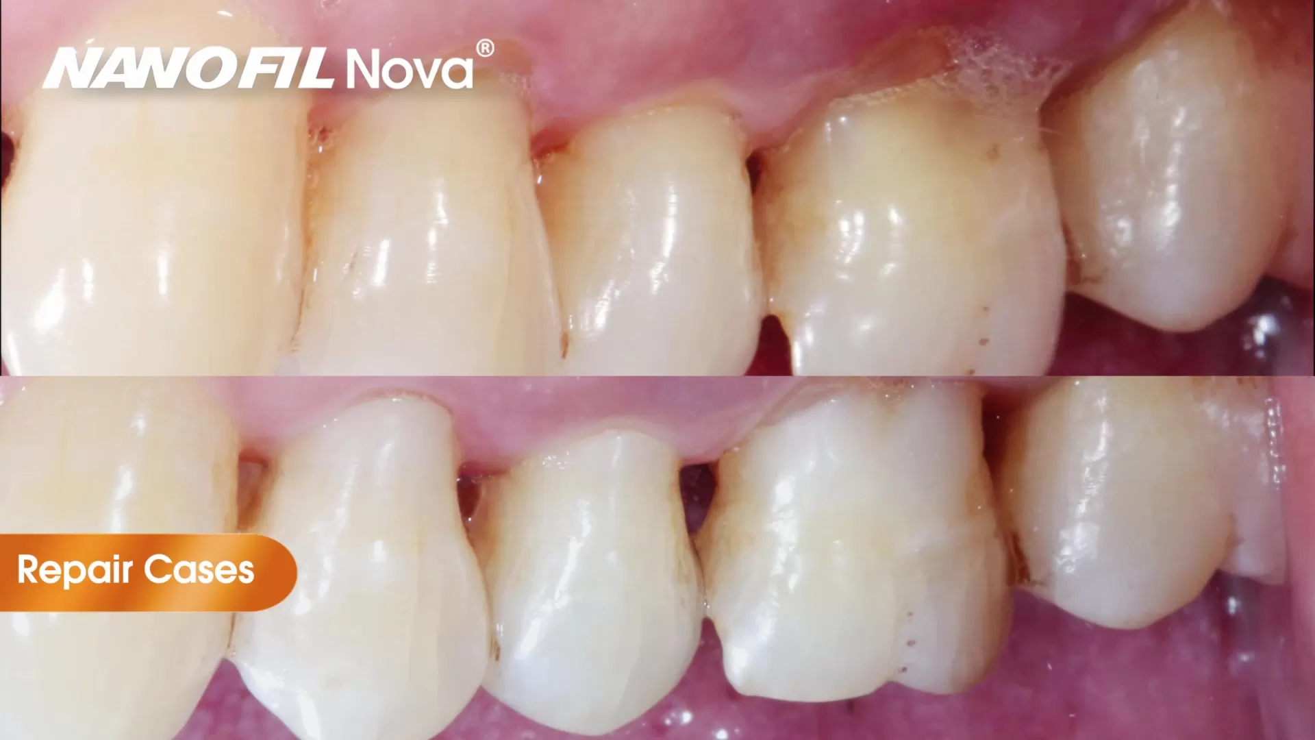 ATBIO NANOFIL Nova® Universal Composite | Clinical Restoration Procedure & Direct Filling Workflow